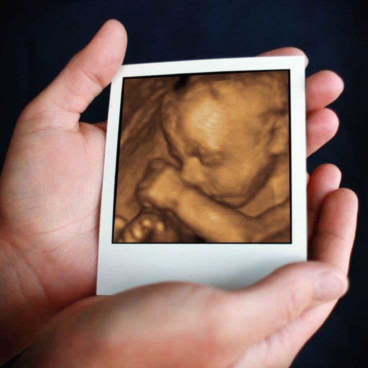 Ultrasound Image